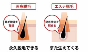 医療脱毛とエステ脱毛の違い