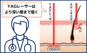 ゴリラクリニックヤグレーザー